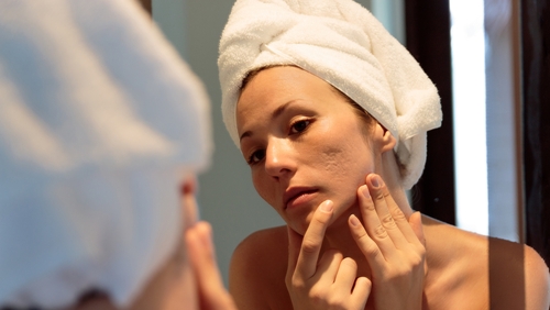 Acne can continue well into adulthood