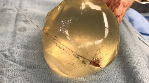 An image shows the bullet trajectory through the implant (Pic: SAGE Medical Journal)