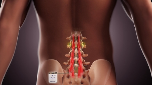 ReActiv8 is a device Mainstay Medical has developed to treat chronic lower back pain