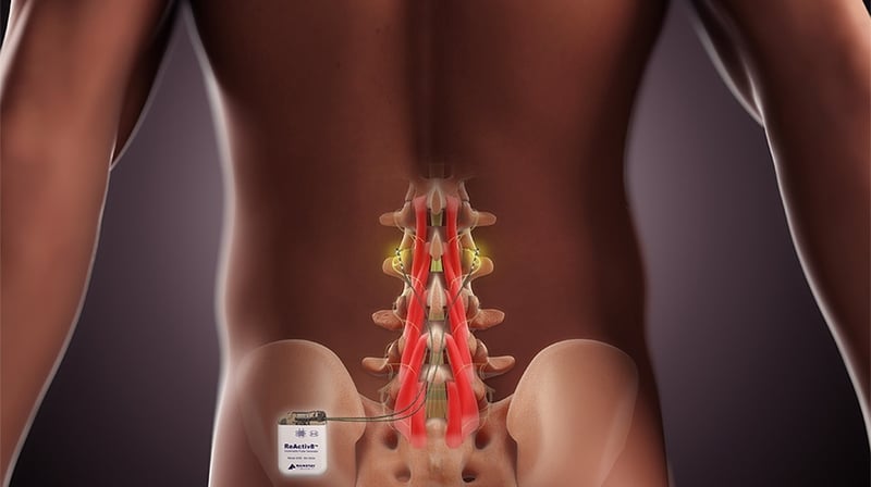 ReActiv8 is a device Mainstay has developed to treat chronic lower back pain