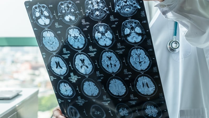 People who suffer from a concussion have a higher risk of dementia in later life, according to the study