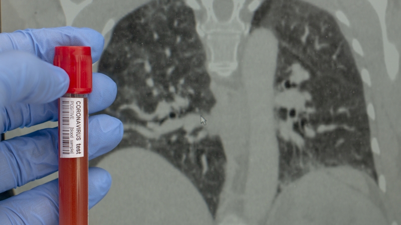 HIQA found patients with mild to moderate Covid-19 unlikely to be infectious beyond ten days from first symptoms