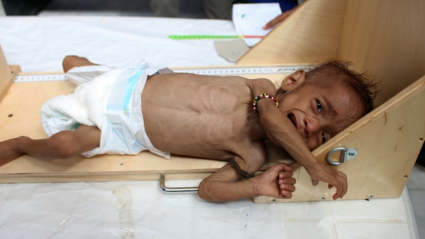 At least 98,000 children under the age of five are at "high risk of dying" unless they receive urgent treatment (File photo)