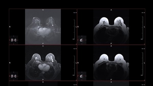 Breast Reconstruction: "I would have had just one general anaesth