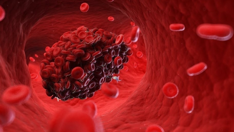 Blood clots can form in the lungs, brain, heart, or veins. Photo SciePro/Shutterstock