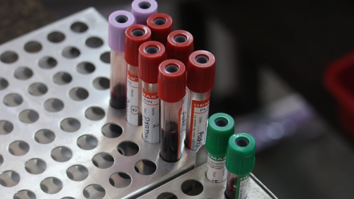 Calls for more screening to test for rare diseases