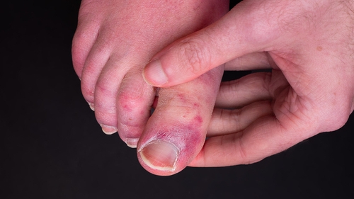 The symptom results in chilblain-like inflammation and redness on the hands and feet (Image: Getty)