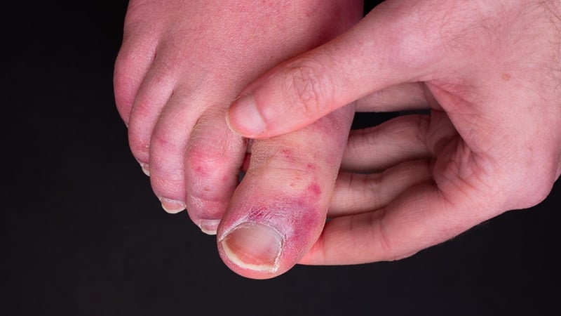 The symptom results in chilblain-like inflammation and redness on the hands and feet (Image: Getty)