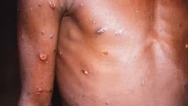 'Unlike Covid, monkeypox does not spread easily from human to human'. Photo: RGB Ventures/ SuperStock/Alamy Stock Photo