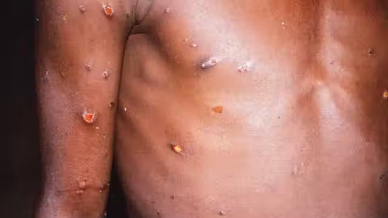 'Unlike Covid, monkeypox does not spread easily from human to human'. Photo: RGB Ventures/ SuperStock/Alamy Stock Photo