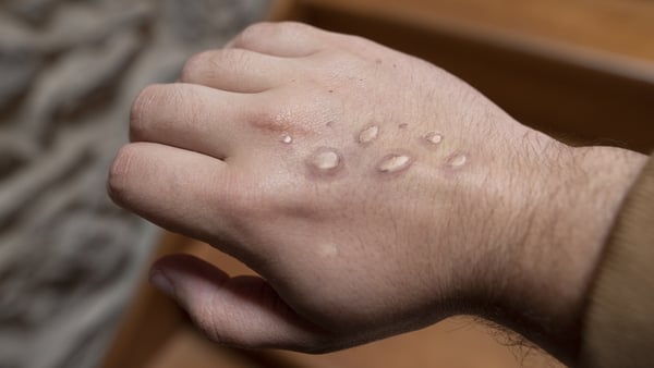 Three monkeypox-related deaths have so far been reported outside Africa in an outbreak that the World Health Organization has declared a global health emergency (file image)