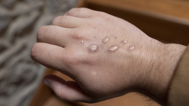 Monkeypox is a rare disease that is related to - but less severe than - smallpox