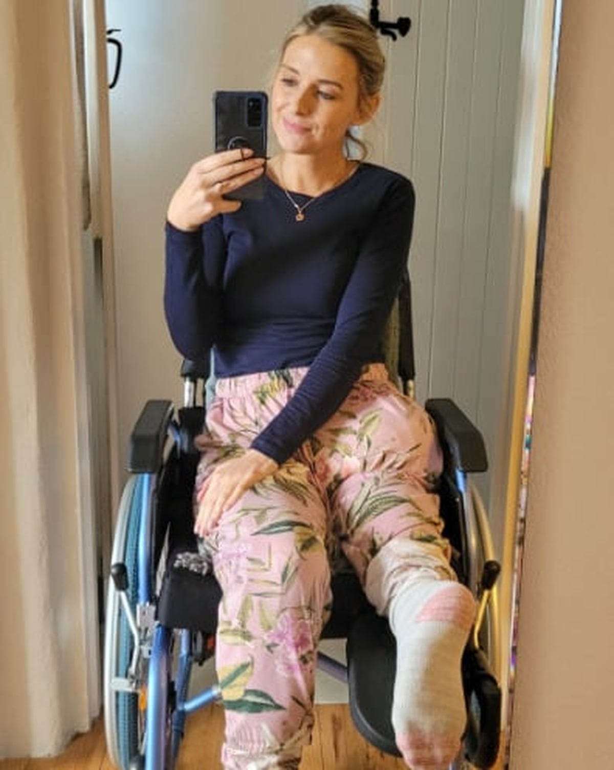 Body Positivity After Amputation 