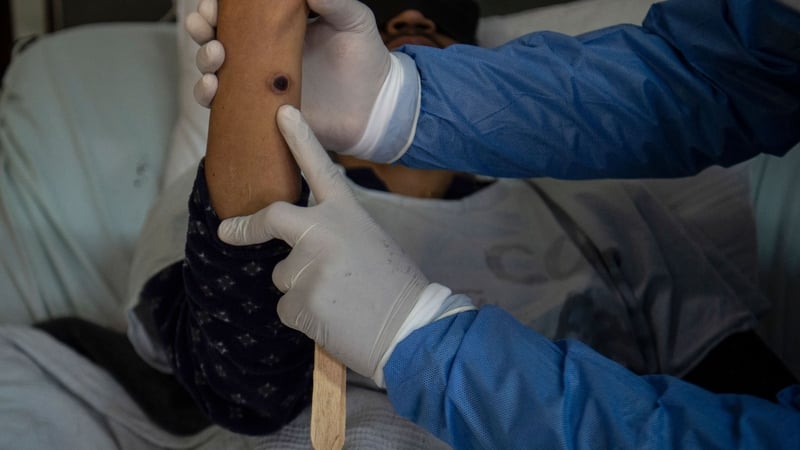 A doctor checks on a patient with sores caused by a monkeypox (File image)