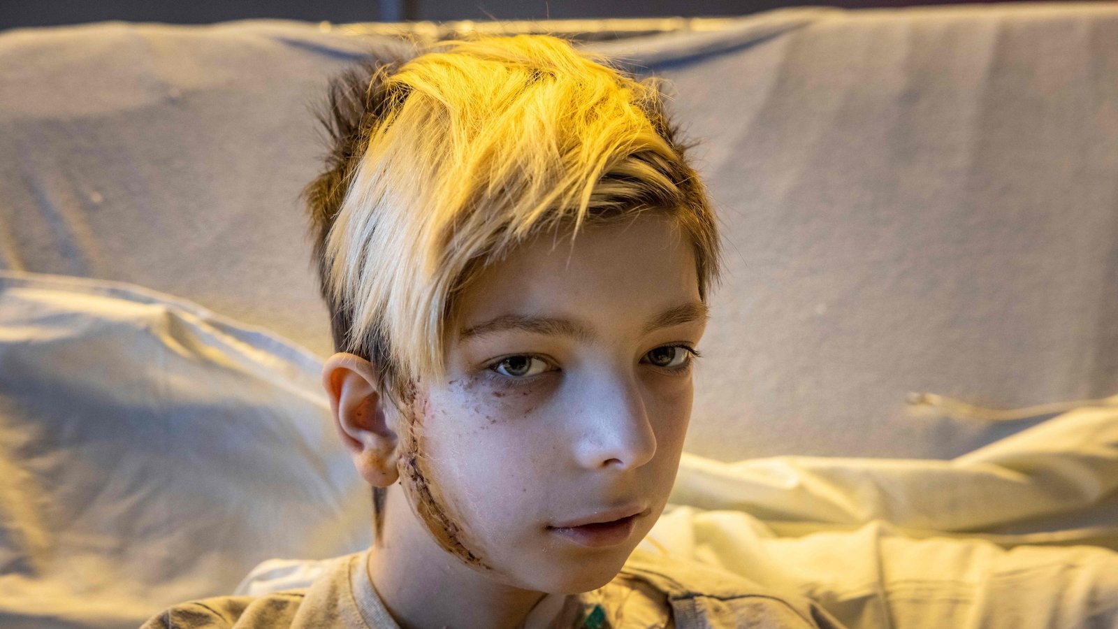 13-year-old Volodymyr pictured in hospital on 19 March 2022 - his family's car was caught in gunfire between Russian and Ukrainian troops in Kyiv, on 26 February. His father was killed and his mother was injured.
