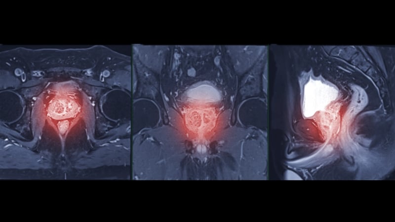 'We tend to think of prostate cancer as one of the more benign cancers as it's survivable in most cases, but it remains a killer'. Photo: Getty Images