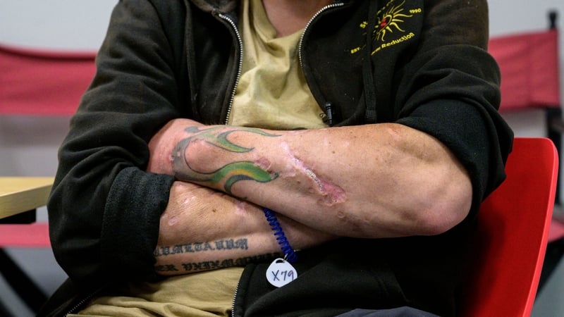 Martin said he is trying to avoid 'tranq', but has wounds on his arms and legs suggesting he may have unknowingly injected it