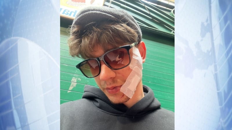 Ukrainian actor Oleksandr Hrekov was attacked on Saturday night (Pic courtesy: Irish Mirror)