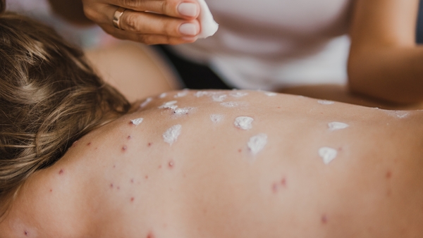 Chickenpox is a common, highly infectious disease mainly affecting children less than ten years old