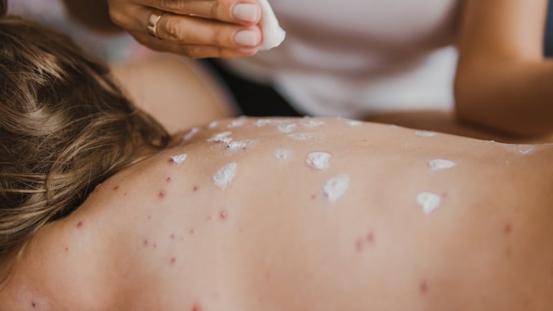 Chickenpox is a common, highly infectious disease mainly affecting children less than ten years old