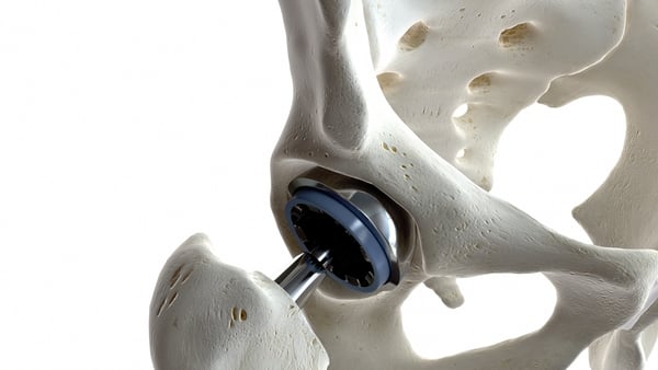'There are two main reasons for implant failure from a materials scientist perspective'. Photo: Getty Images