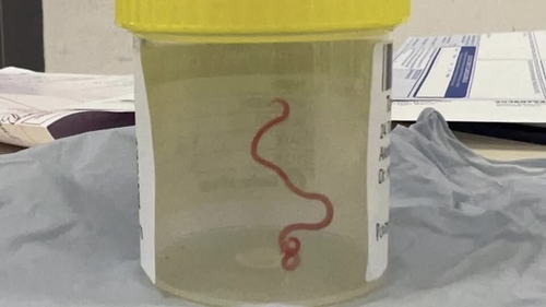 It was an 8cm roundworm which researchers said was a common parasite in kangaroos and carpet pythons, but not humans