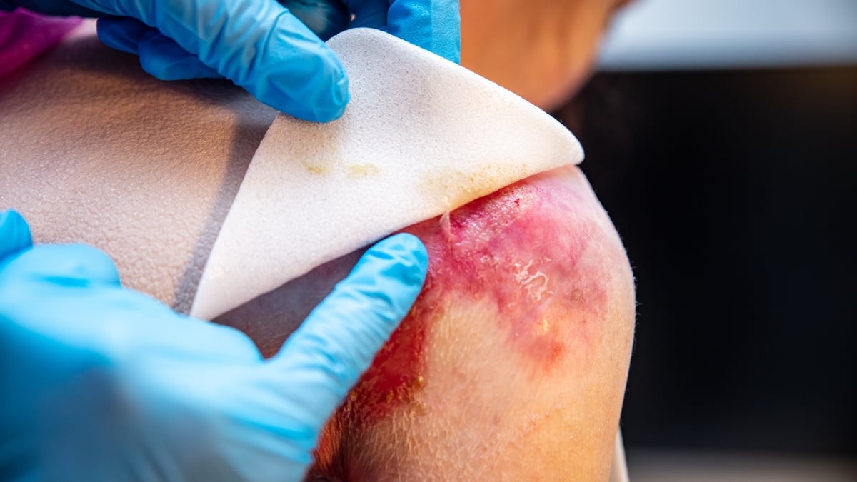 Report shows gap between EB skin condition patients' needs and what they receive