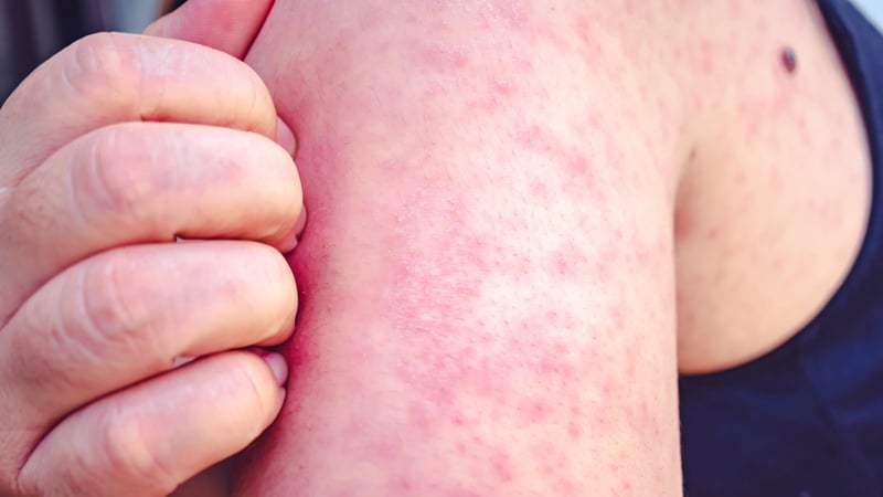 It is the first confirmed measles case notified in Ireland this year, the HSE said