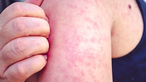 'Measles can cause chest infections, febrile convulsions, ear infections, swelling of the brain and brain damage, deafness and death.' Photo: Getty Images