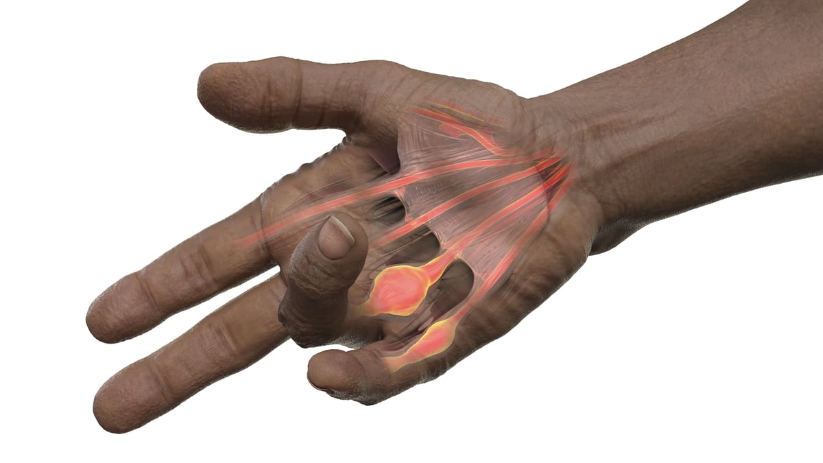Dupuytren's Contracture