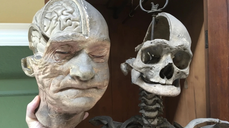 Plaster cast and skeleton of centenarian James Conway. Photo: Siobhan Ward/Biomedical Sciences Institute/Trinity College Dublin