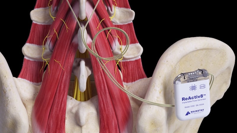 Mainstay Medical's ReActiv8 device is used to treat chronic lower back pain