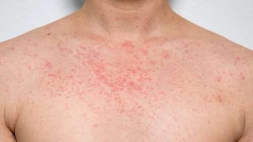 Measles is a highly infectious disease that can cause serious complications (Stock image)