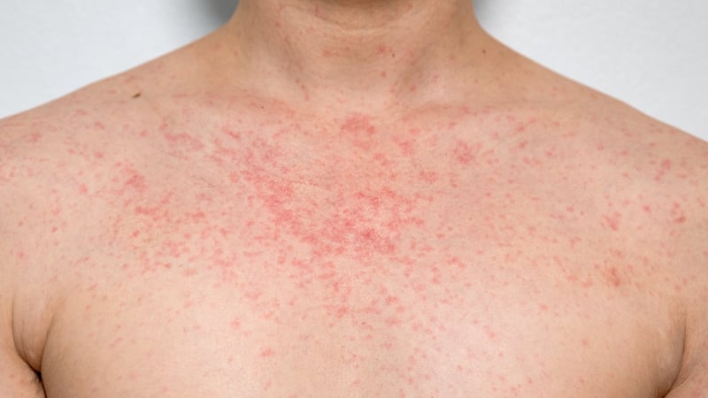 HSE's measles catch- up vaccination programme for around 300,000 people is due to be launched next week (Stock image)