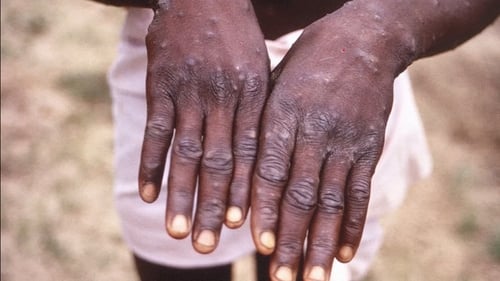 The viral infection is spread through close contact