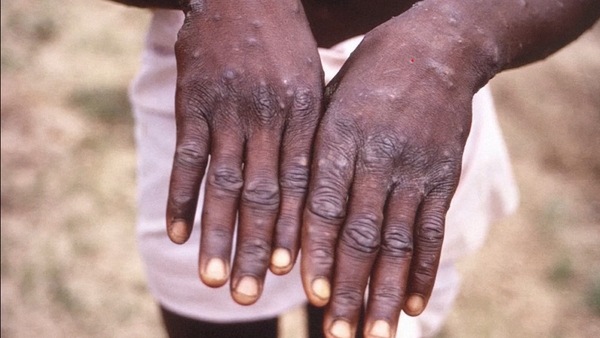 The viral infection is spread through close contact
