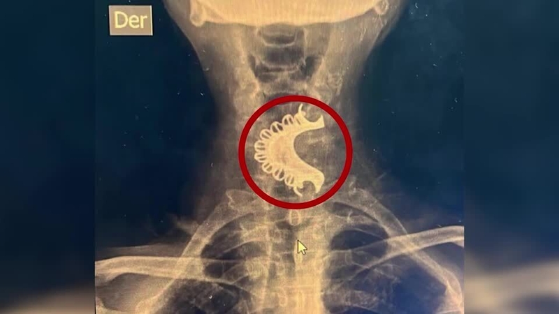 The man thought he had spat out his dentures during an epileptic episode but had unknowingly swallowed them (credit: EsSalud handout)