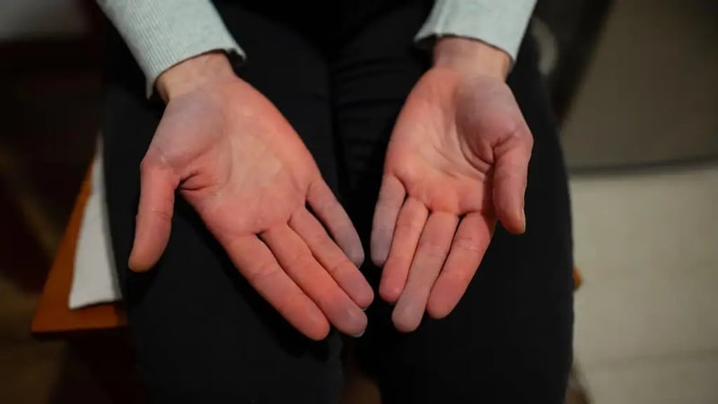Raynaud's is a common phenomenon (Alamy/PA)