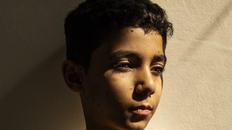 The picture depicts Mahmoud Ajjour, evacuated to Doha after an explosion severed one arm and mutilated the other last year