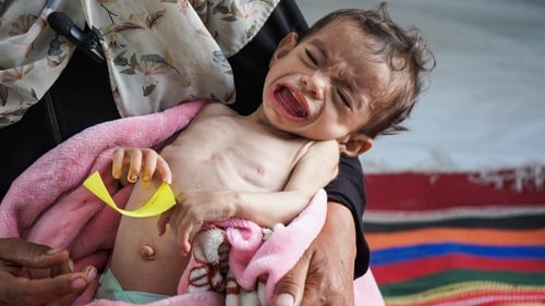Eleven-month-old Zakaria El-Mabhuh is one of hundreds of children diagnosed with malnutrition in Gaza
