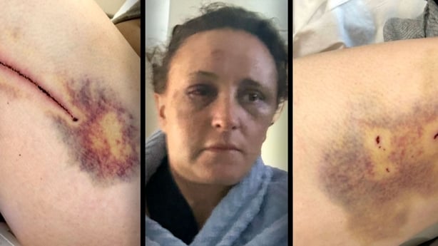 Natalie Ennis injuries