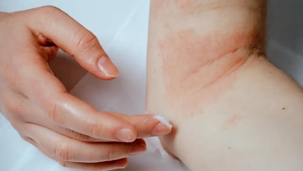 person applying lotion to psoriasis