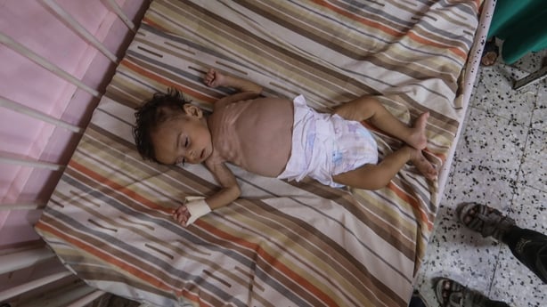 A picture taken in a hospital in Gaza shows a child who is suffering from severe weight loss and malnutrition