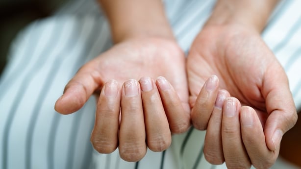 brittle damaged nails 