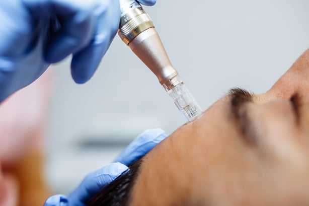 Close up of cosmetologist holding tool with needle used for dermapen treatment on patient's forehead, ready to start procedure. Device allow to pierce skin, triggering natural healing response.