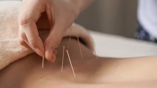 acupuncture on back