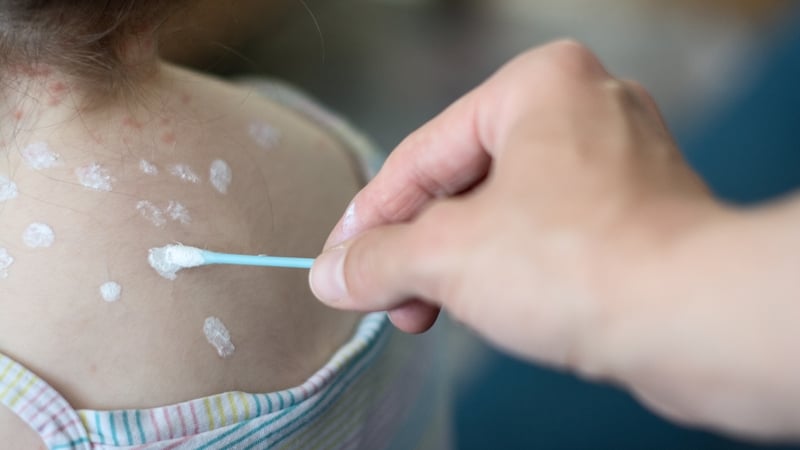 The vaccine will be available once a child turns 12 months of age as part of the routine childhood immunisation schedule