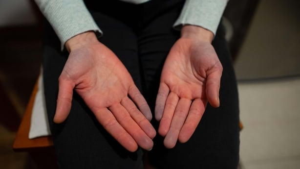 A woman with poor circulation in her hands