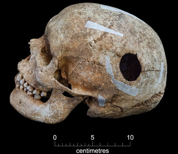 Undated handout photo issued by Cambridge Archaeological Unit of a skull found in the burial pit