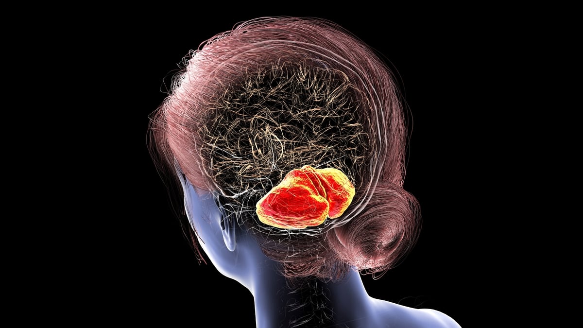 Call for drug for rare neuromuscular disease to be approved for Ireland